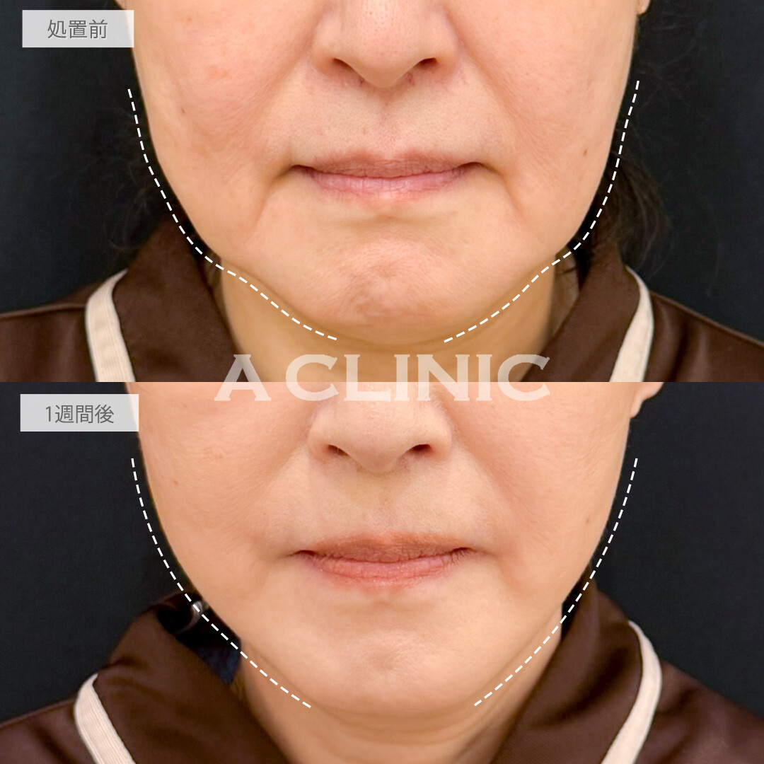 A式たるみ切開で徐々に下がってくるフェイスラインを一気に引き上げ！処置前と1週間後の症例です(60代女性)