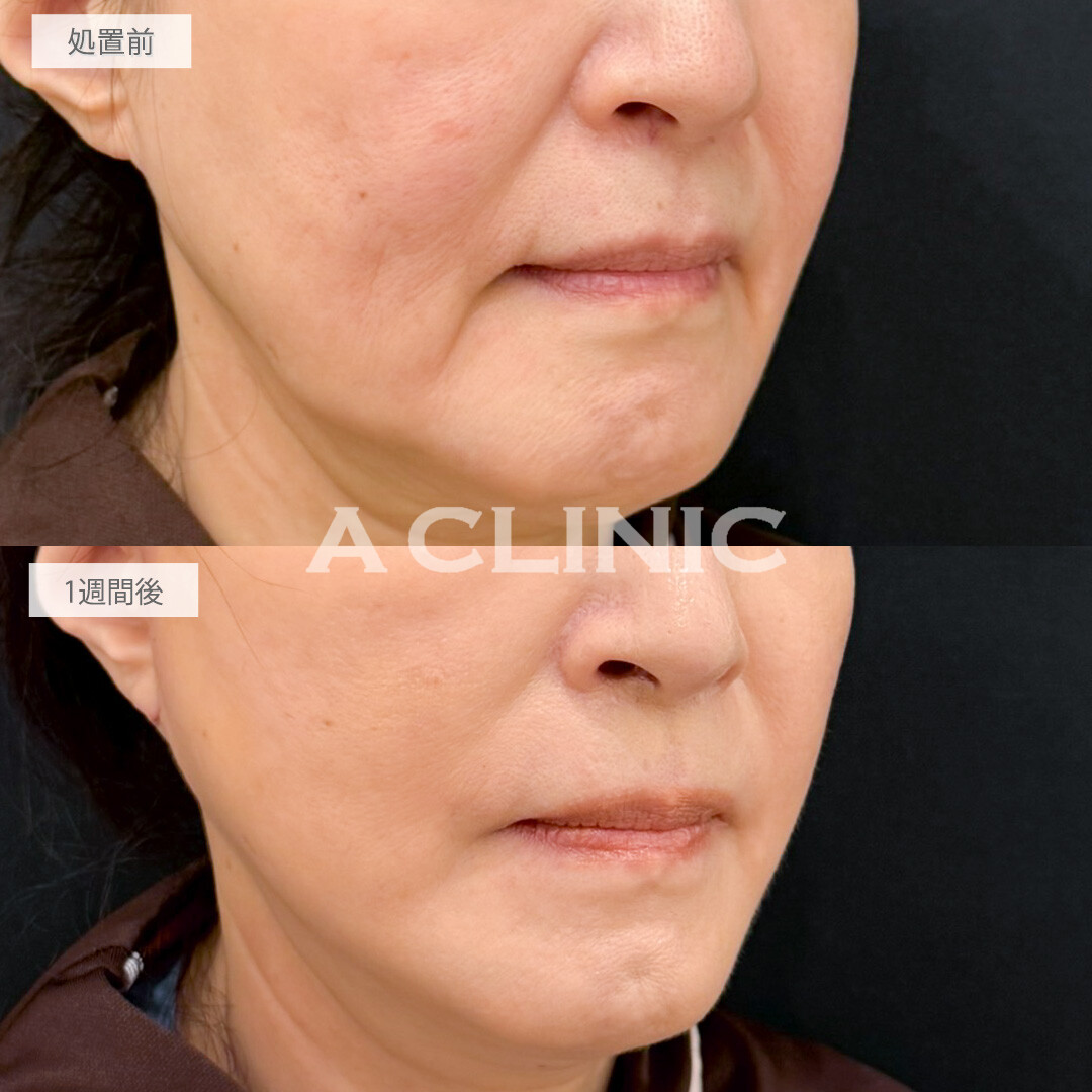A式たるみ切開で徐々に下がってくるフェイスラインを一気に引き上げ！処置前と1週間後の症例です(60代女性)