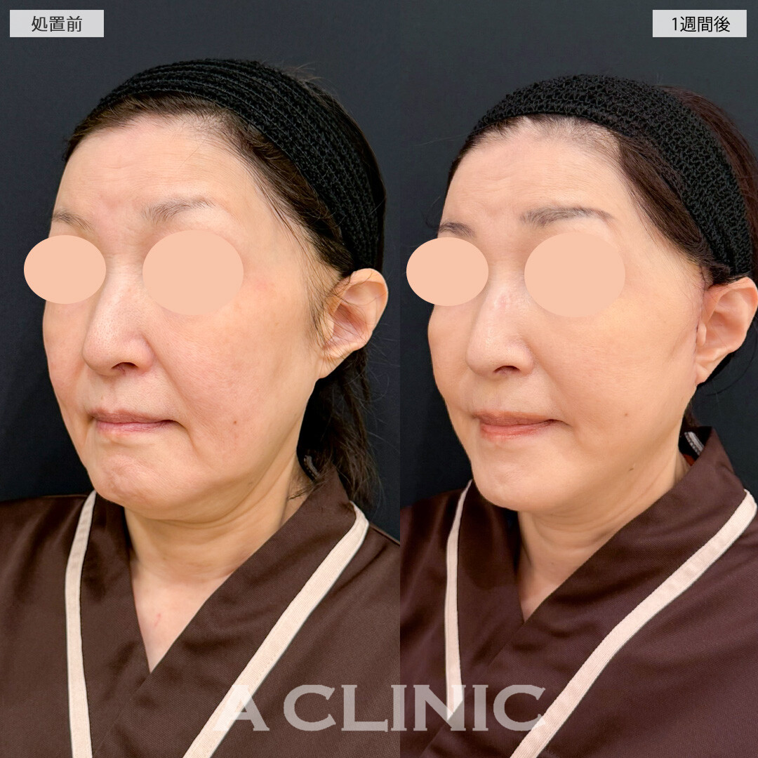 A式たるみ切開で徐々に下がってくるフェイスラインを一気に引き上げ！処置前と1週間後の症例です(60代女性)