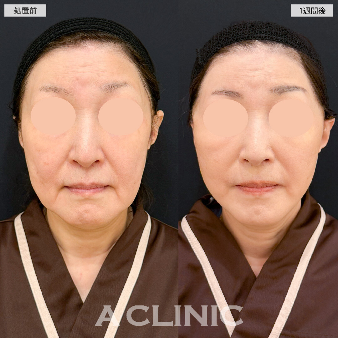 A式たるみ切開で徐々に下がってくるフェイスラインを一気に引き上げ！処置前と1週間後の症例です(60代女性)