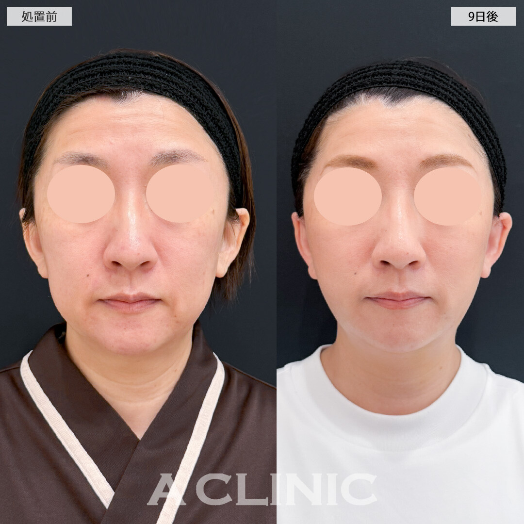 1day小顔脂肪吸引とA式たるみ切開であっという間に若返り効果を実感できました！処置前と9日後の症例です(40代女性)