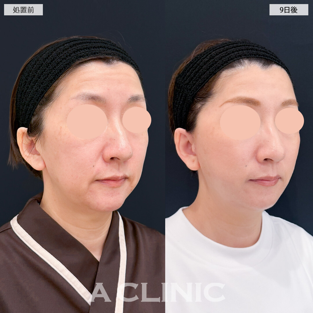 1day小顔脂肪吸引とA式たるみ切開であっという間に若返り効果を実感できました！処置前と9日後の症例です(40代女性)