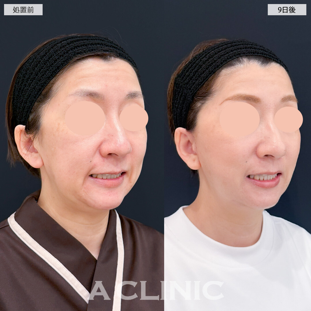 1day小顔脂肪吸引とA式たるみ切開であっという間に若返り効果を実感できました！処置前と9日後の症例です(40代女性)