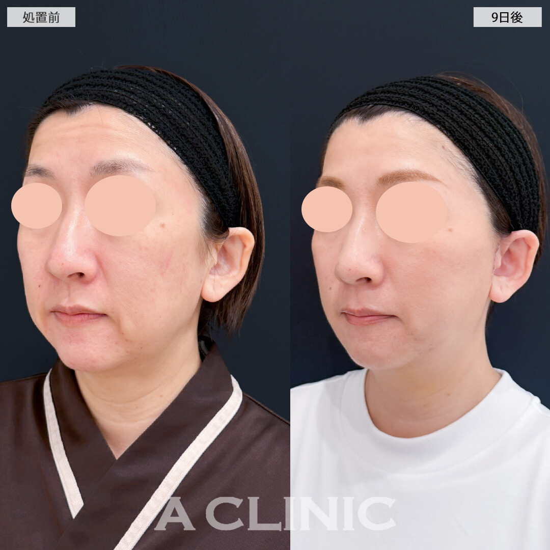 1day小顔脂肪吸引とA式たるみ切開であっという間に若返り効果を実感できました！処置前と9日後の症例です(40代女性)