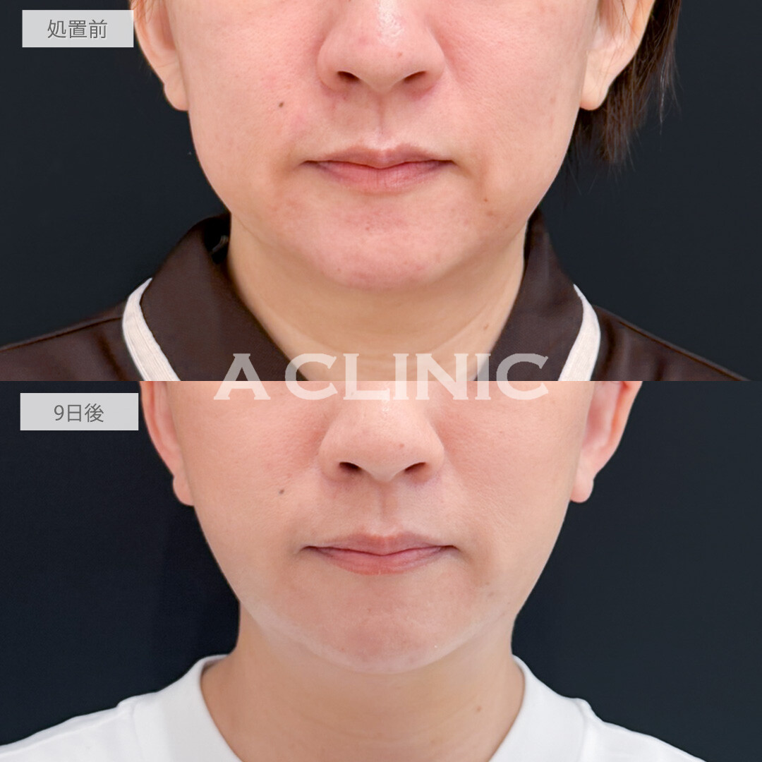 1day小顔脂肪吸引とA式たるみ切開であっという間に若返り効果を実感できました！処置前と9日後の症例です(40代女性)