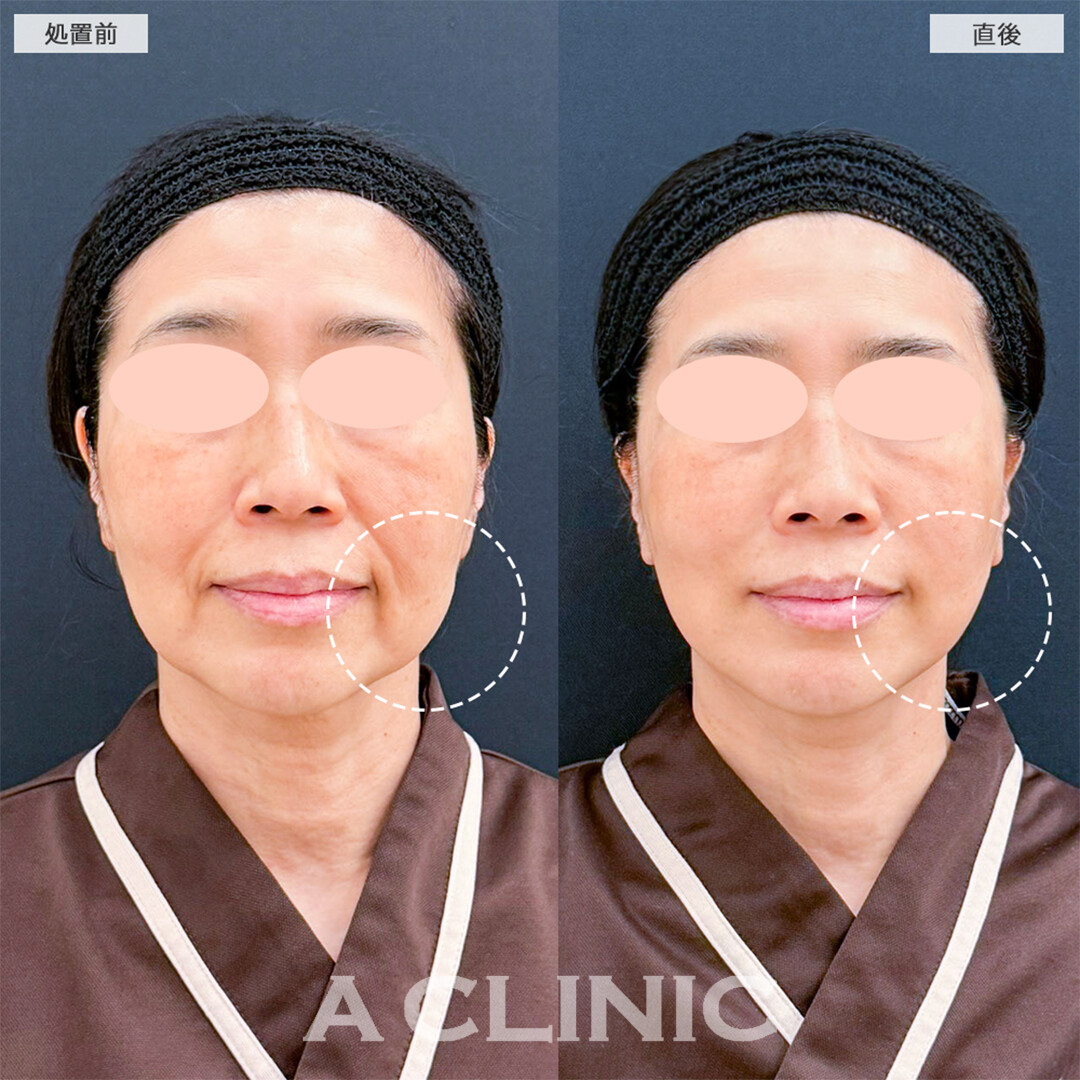 【直後の傷跡あり】A式たるみ切開で余分なたるみを除去！こちら処置前と直後の症例です(50代女性)