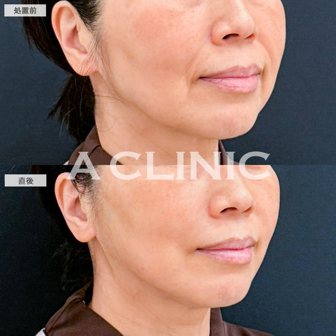 【直後の傷跡あり】A式たるみ切開で余分なたるみを除去！こちら処置前と直後の症例です(50代女性)