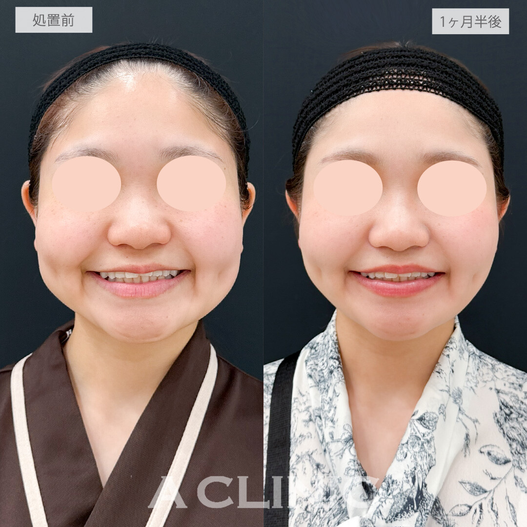 1day小顔脂肪吸引とバッカルファット除去術でナチュラルに顔痩せ大成功しました！処置前と1ヶ月半後の症例です(20代女性)