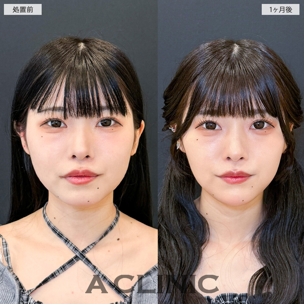 1day小顔脂肪吸引で丸顔解消！こちら処置前と1ヶ月後の症例です(20代女性)