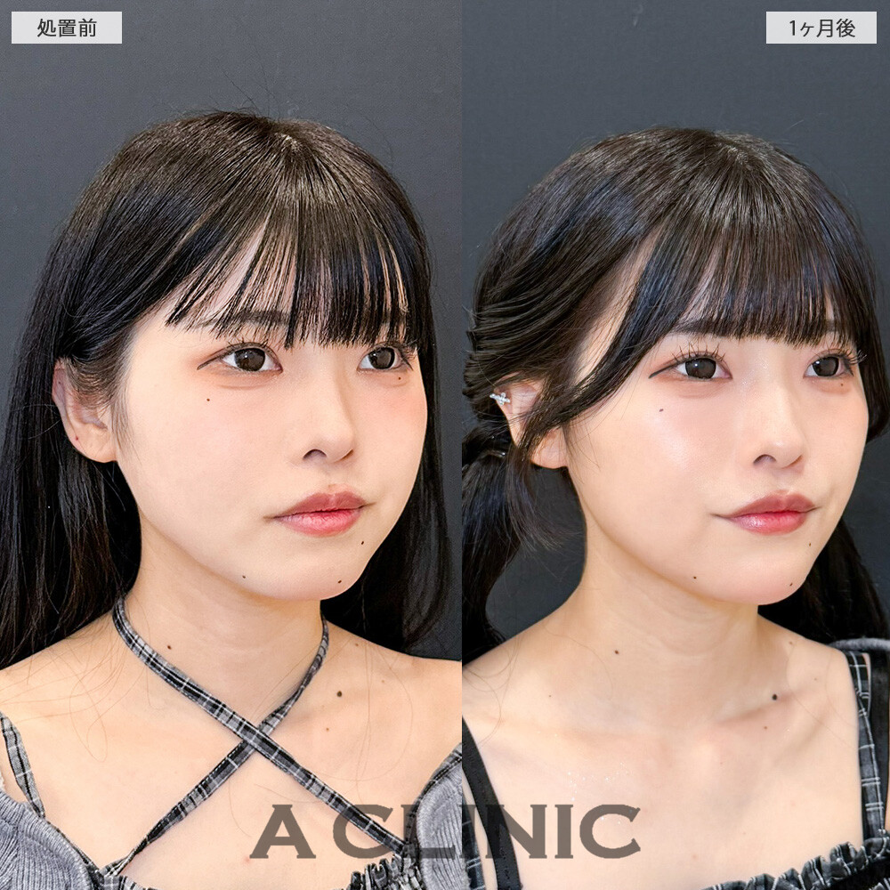 1day小顔脂肪吸引で丸顔解消！こちら処置前と1ヶ月後の症例です(20代女性)