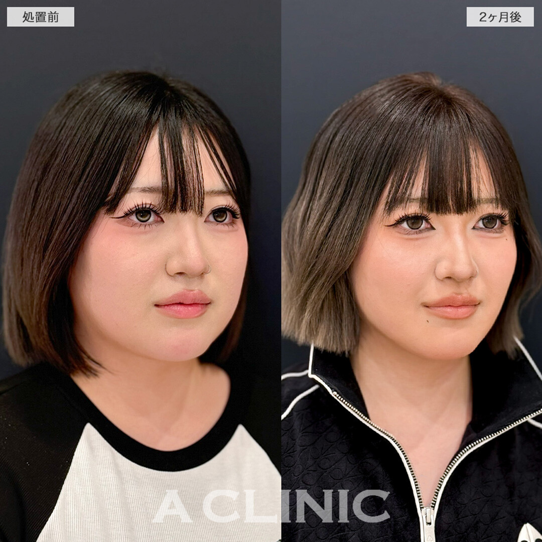 1day小顔脂肪吸引とバッカルファット除去術でお顔の余白を減らしてシャープな輪郭へ！こちら処置前と2か月後の症例です(20代女性)