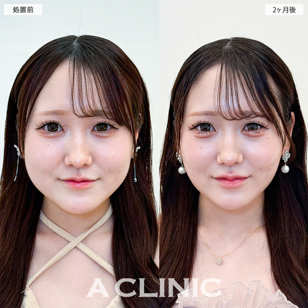 1day小顔脂肪吸引と小顔エラボトックスでお顔の面積が減り更に可愛くなりました！こちら処置前と2ヶ月後の症例です(10代女性)