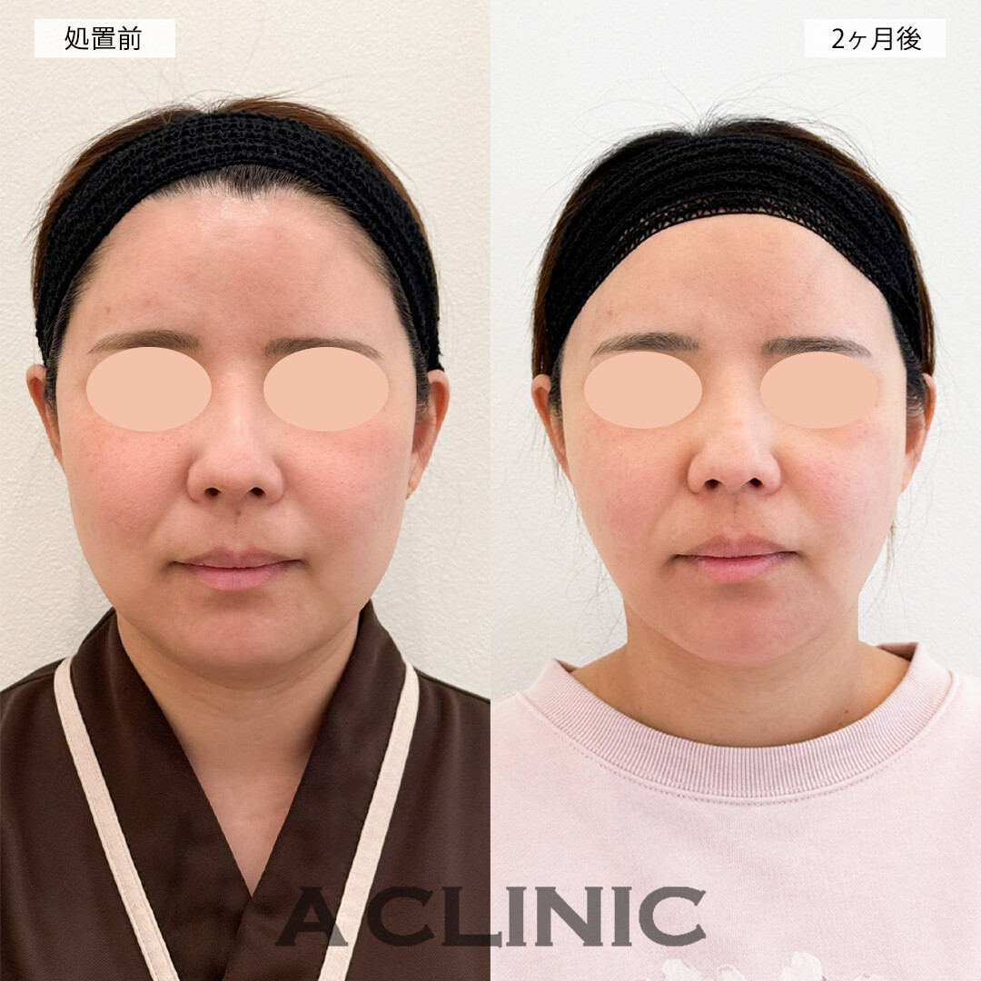 1day小顔脂肪吸引で顔が一回りほど小さくなり痩せた印象に！こちら処置前と2ヶ月後の症例です(30代女性)