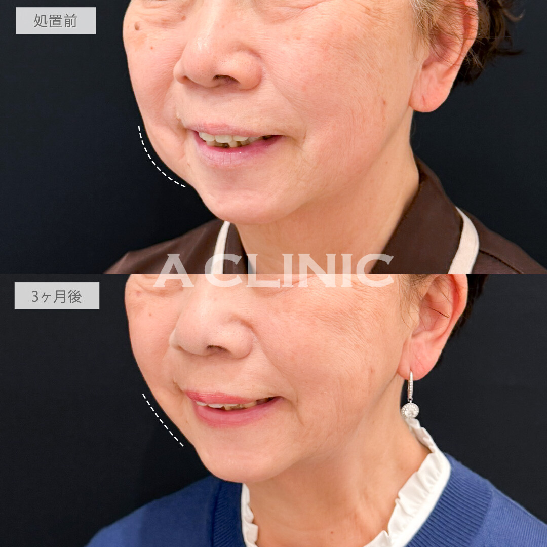 1day小顔脂肪吸引とバッカルファット除去術でたるんできた脂肪をなくしていつまでも若々しい輪郭を保てます！処置前と3ヶ月後の症例です(70代女性)