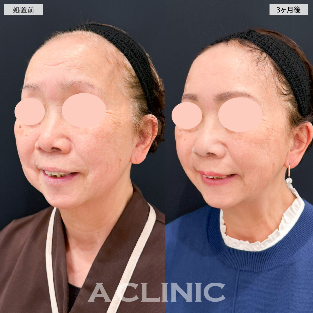 1day小顔脂肪吸引とバッカルファット除去術でたるんできた脂肪をなくしていつまでも若々しい輪郭を保てます！処置前と3ヶ月後の症例です(70代女性)
