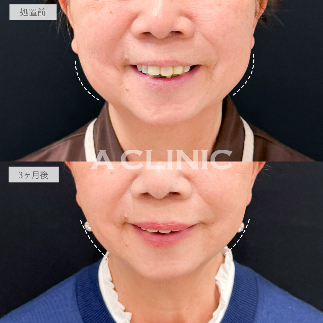 1day小顔脂肪吸引とバッカルファット除去術でたるんできた脂肪をなくしていつまでも若々しい輪郭を保てます！処置前と3ヶ月後の症例です(70代女性)