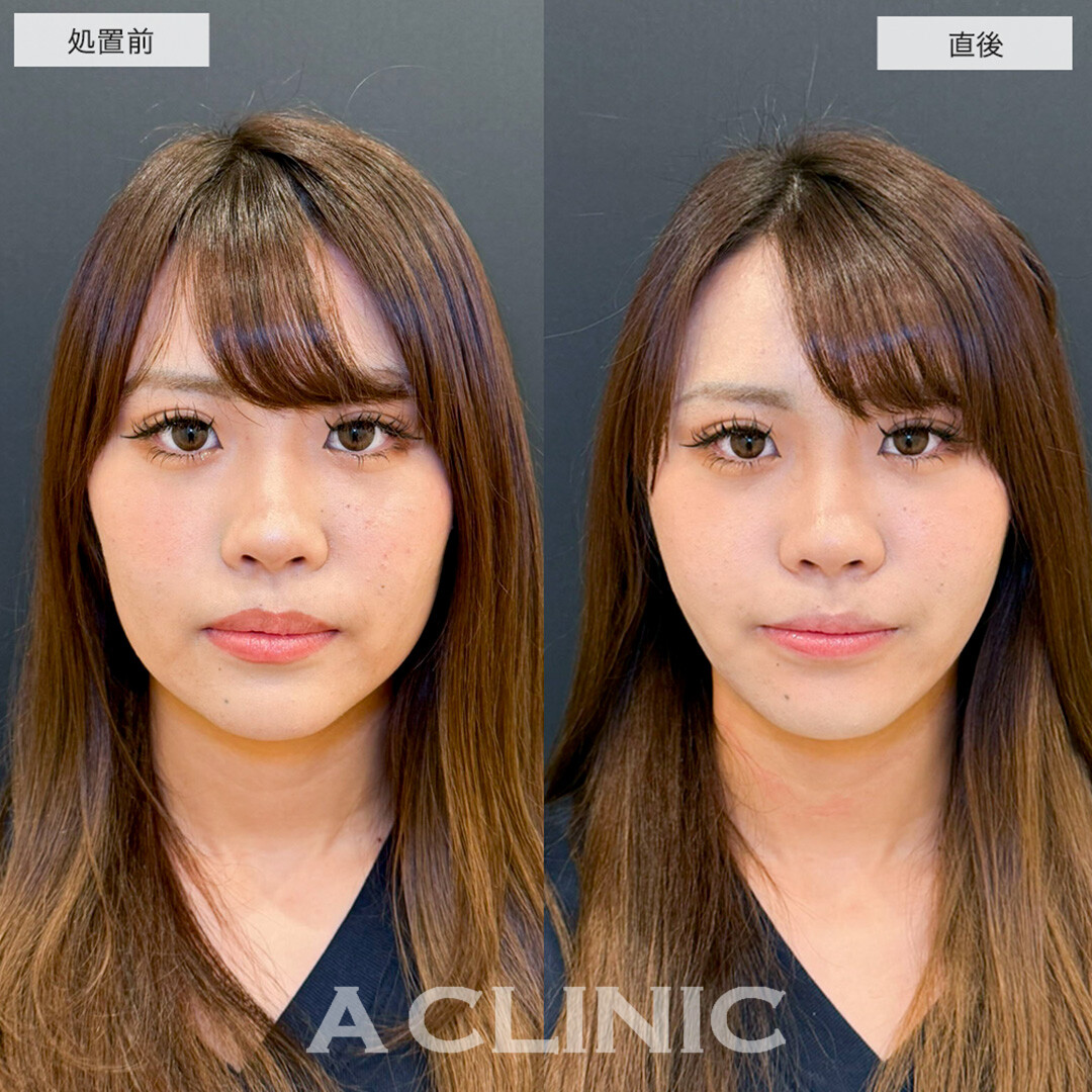 1day小顔脂肪吸引で骨格を活かしながら理想の小顔へ!こちら処置前と直後の症例です(20代女性)