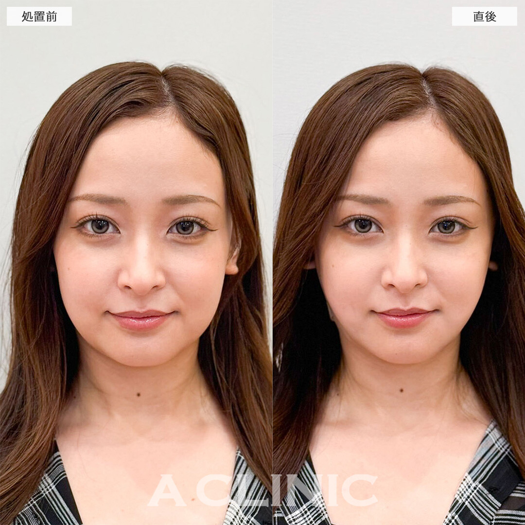 1day小顔脂肪吸引なら直後から腫れ最小限なのに効果を実感できる！こちら処置前と直後の症例です(20代女性)