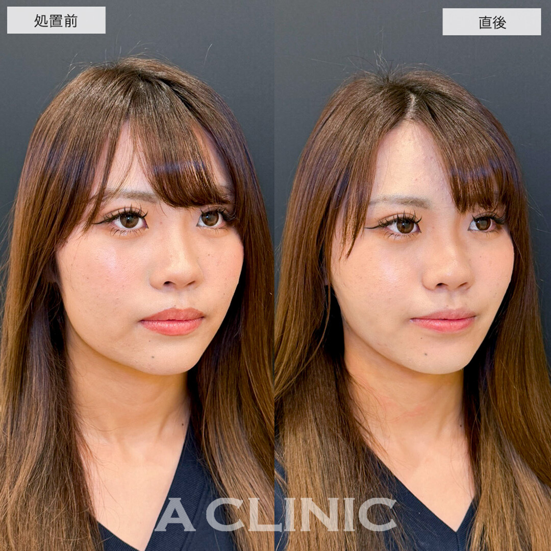 1day小顔脂肪吸引で骨格を活かしながら理想の小顔へ!こちら処置前と直後の症例です(20代女性)