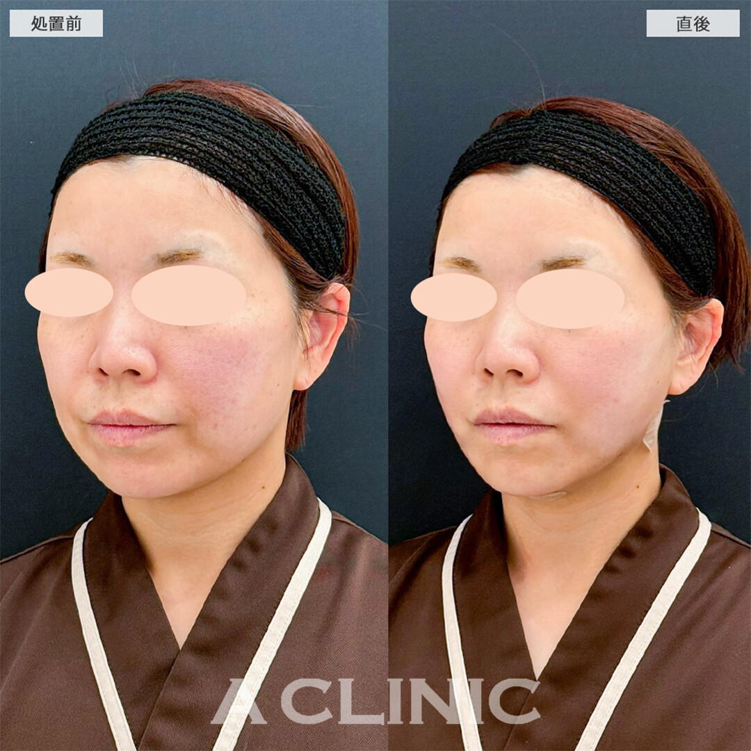1day小顔脂肪吸引で下顔面の悩みが解消されスッキリした輪郭に！こちら処置前と直後の症例です(30代女性)