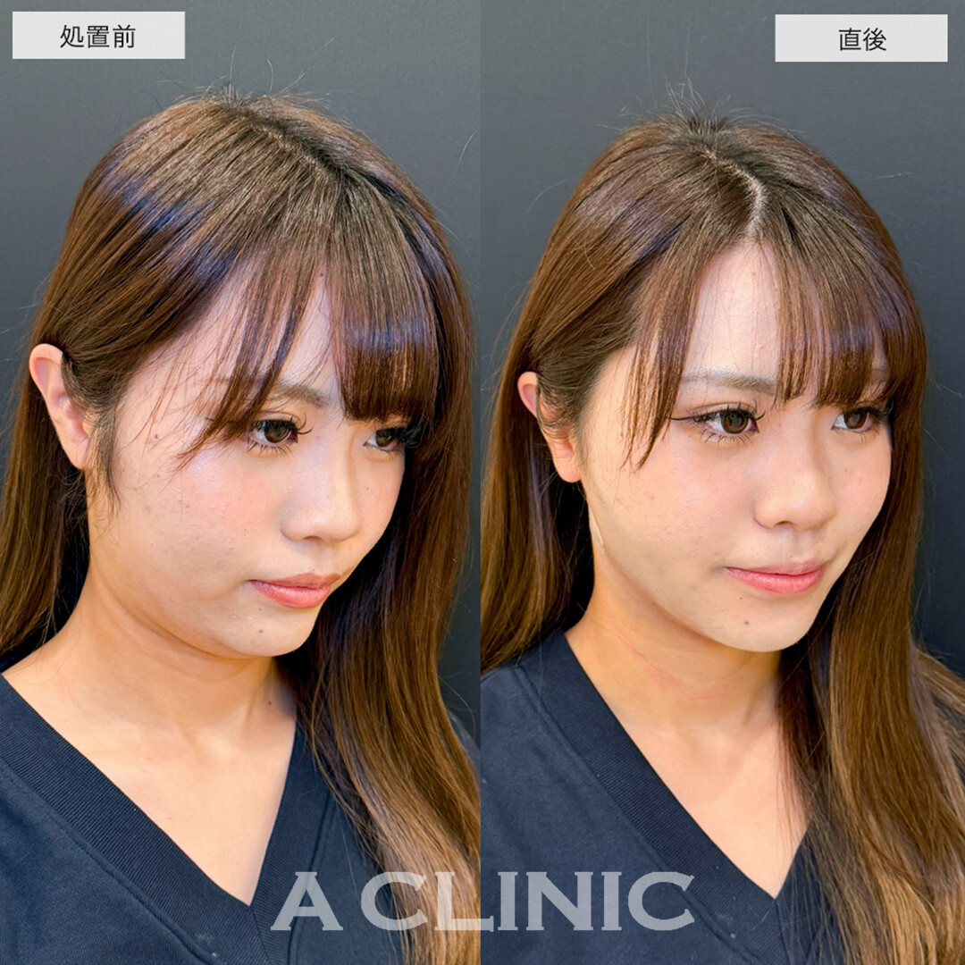 1day小顔脂肪吸引で骨格を活かしながら理想の小顔へ!こちら処置前と直後の症例です(20代女性)