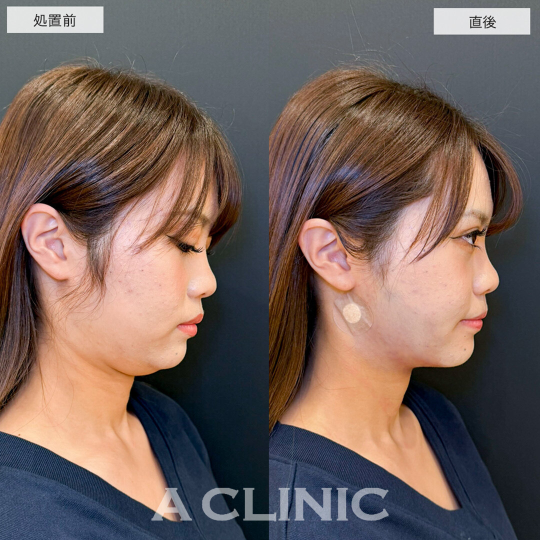 1day小顔脂肪吸引で骨格を活かしながら理想の小顔へ!こちら処置前と直後の症例です(20代女性)