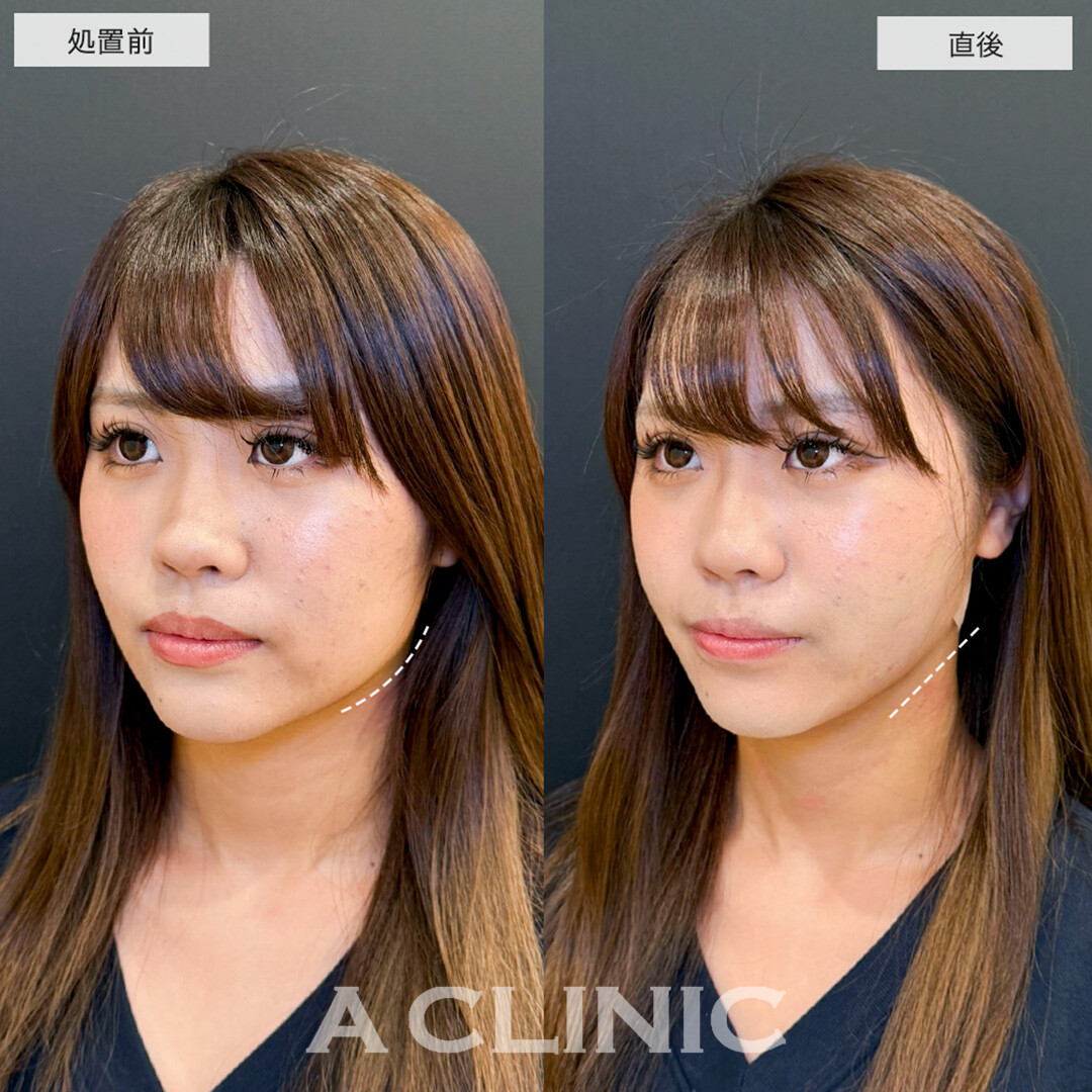 1day小顔脂肪吸引で骨格を活かしながら理想の小顔へ!こちら処置前と直後の症例です(20代女性)