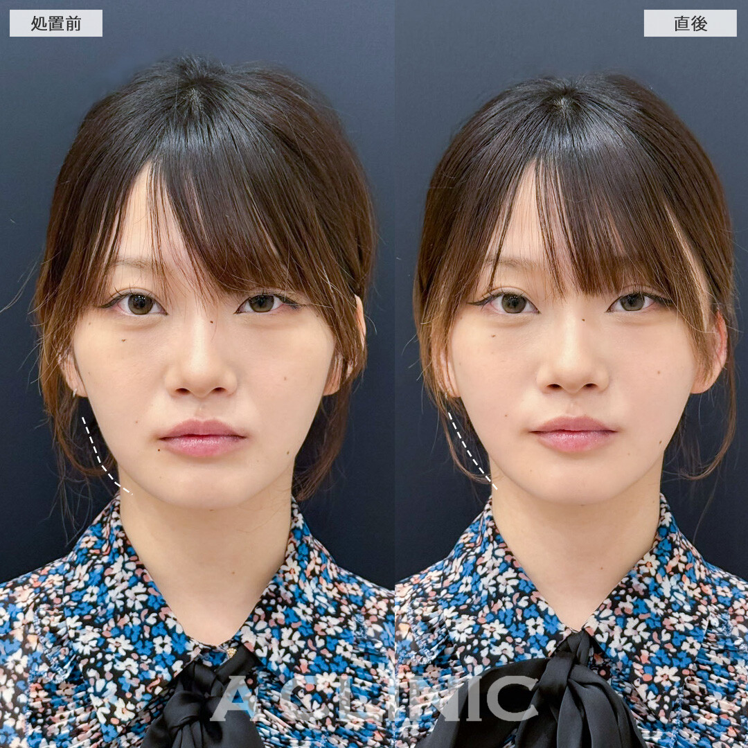 Aスレッドでダイエット後のたるみを撃退！こちら処置前と直後の症例です(20代女性)