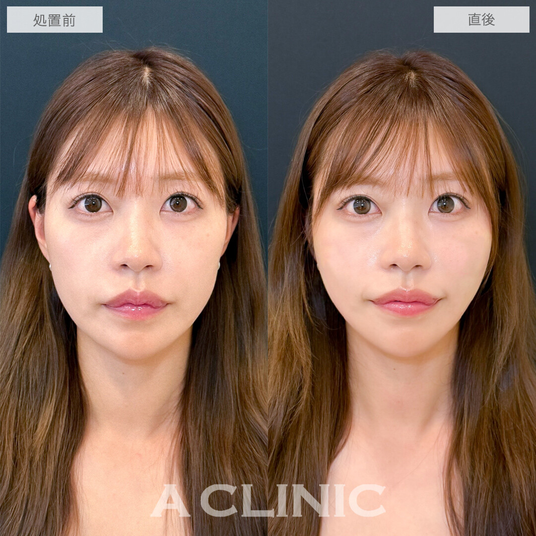 Aスレッドで理想通りのVフェイスに！処置前と直後の症例です(20代女性)