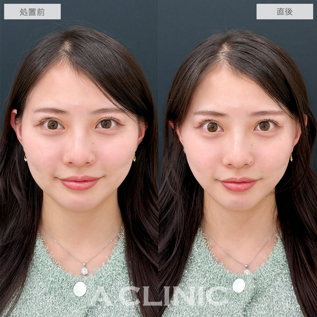 Aスレッドなら即日で美フェイスラインが手に入る！処置前と直後の症例です(20代女性)
