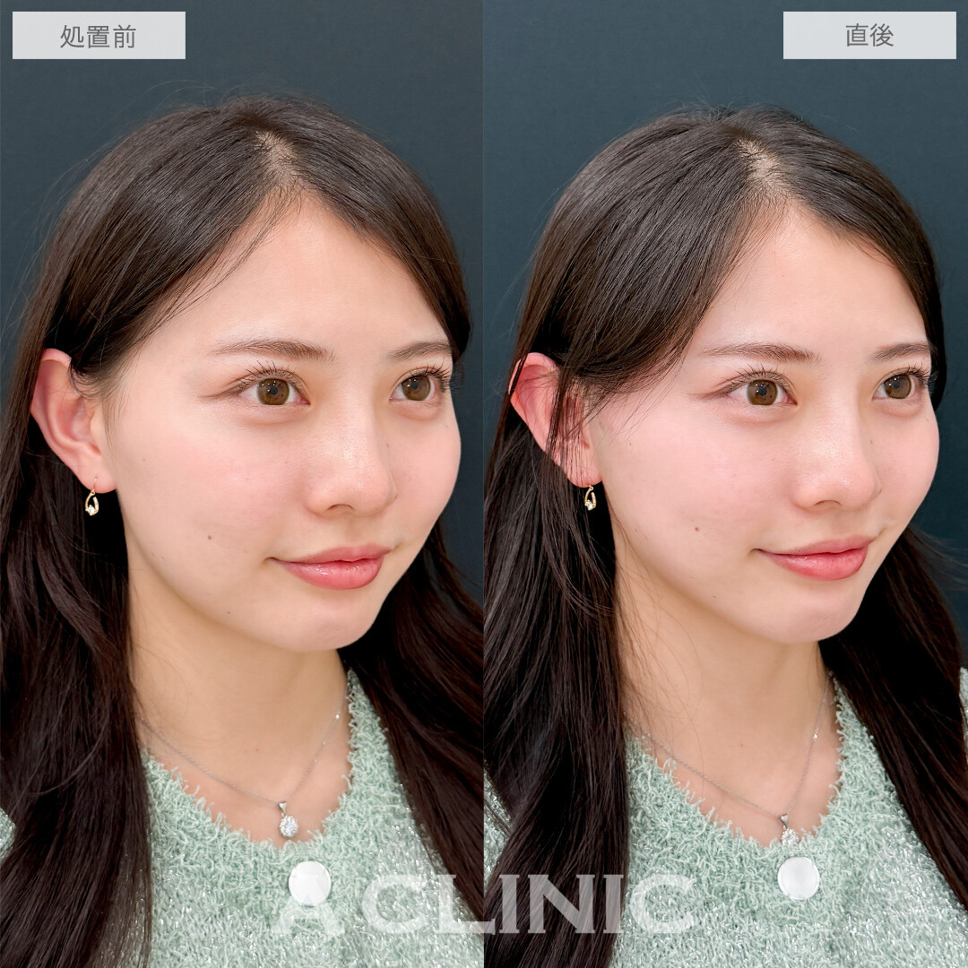 Aスレッドなら即日で美フェイスラインが手に入る！処置前と直後の症例です(20代女性)