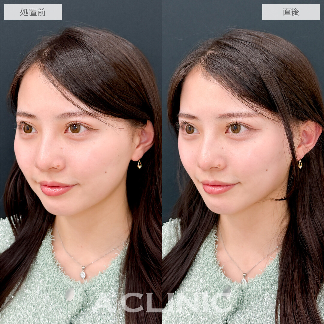 Aスレッドなら即日で美フェイスラインが手に入る！処置前と直後の症例です(20代女性)