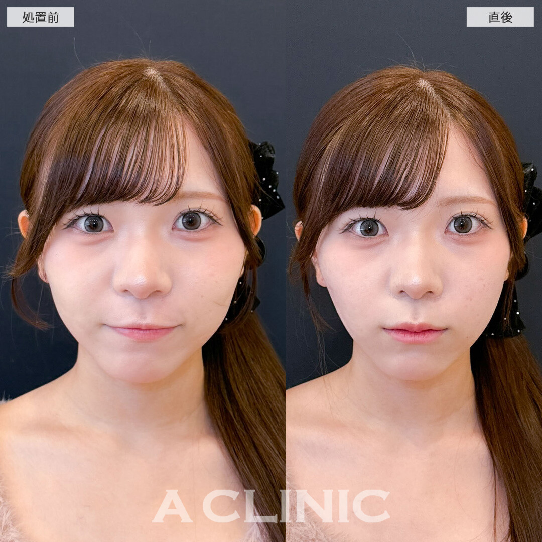 Aスレッドでキュッと引き締まった理想の小顔へ！こちら処置前と直後の症例です(10代女性)