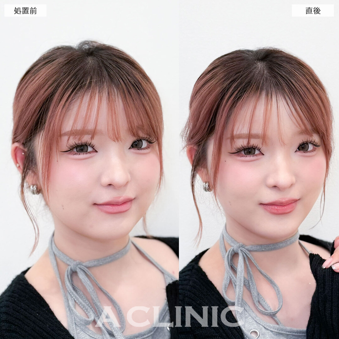 Aスレッドでお顔の余白をギュッと縮めました！こちら処置前と直後の症例です(20代女性)