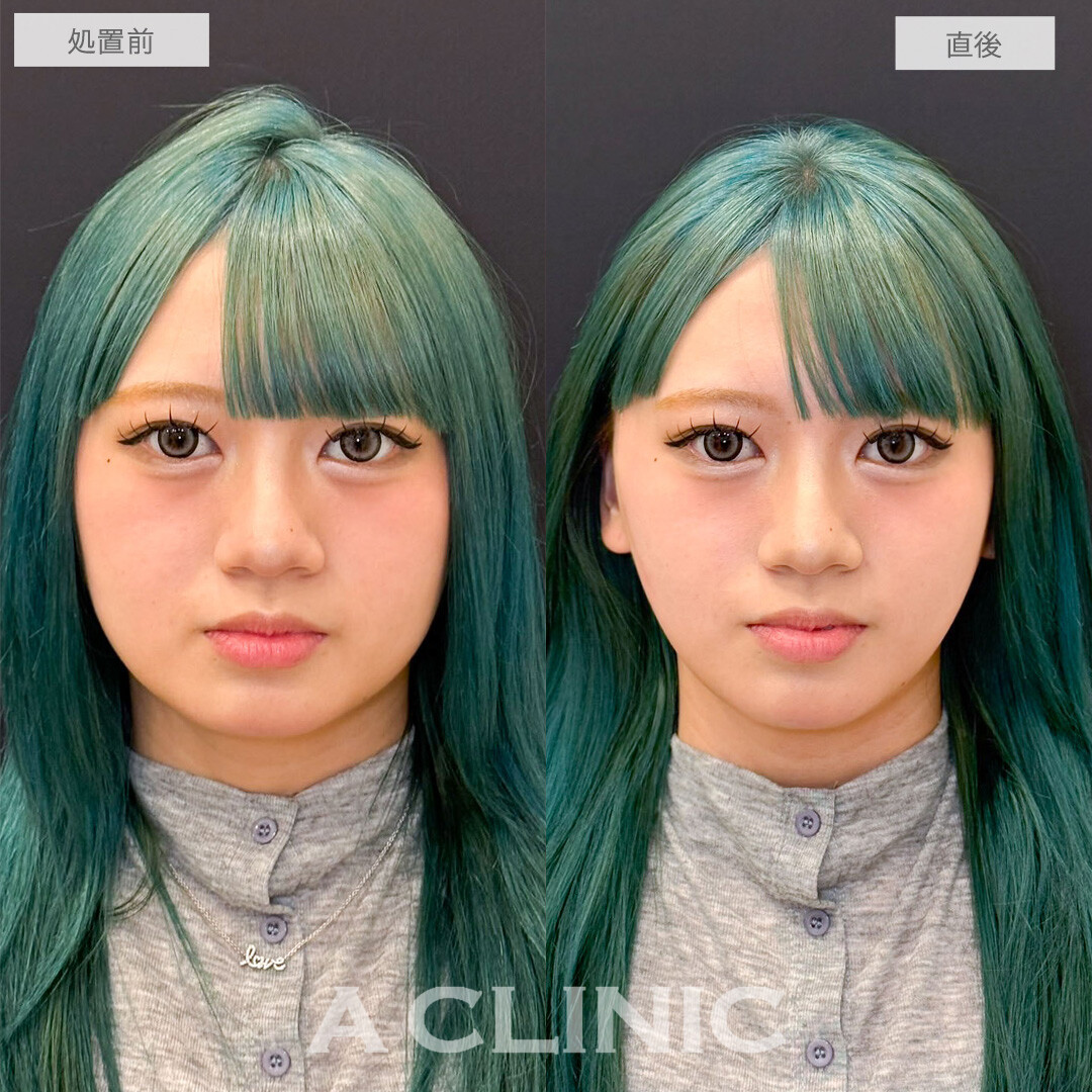 Aスレッドでフェイスラインのもたつき改善しＶフェイスに近づきました！こちら処置前と直後の症例です(20代女性)