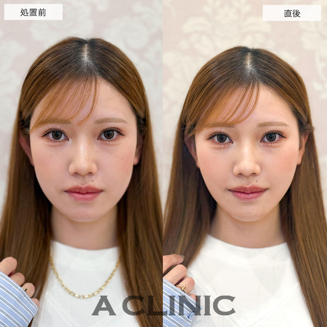 Aスレッドとあごへのヒアルロン酸注入を組み合わせて理想のVフェイスへ!こちら処置前と直後の症例です(20代女性)