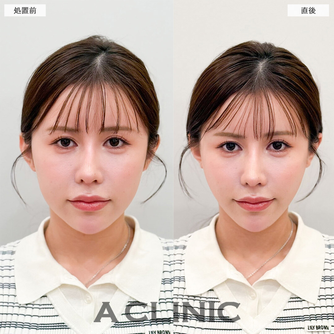 Aスレッドならダウンタイム最小限で加工級の小顔が手に入る！こちら処置前と直後の症例です(20代女性)