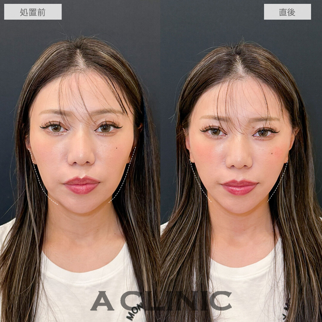 Aスレッドで直後から綺麗なVフェイスに！こちら処置前と直後の症例です(30代女性)