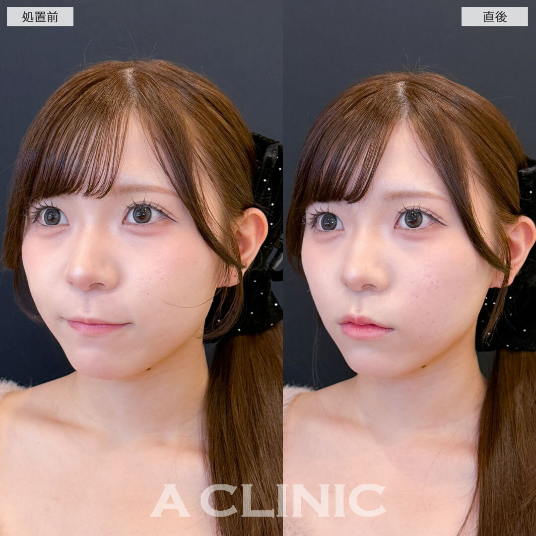 Aスレッドでキュッと引き締まった理想の小顔へ！こちら処置前と直後の症例です(10代女性)