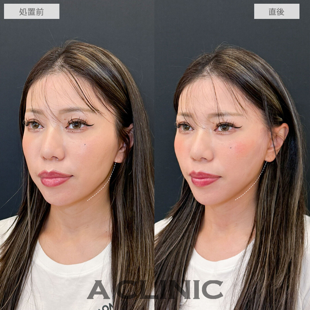 Aスレッドで直後から綺麗なVフェイスに！こちら処置前と直後の症例です(30代女性)