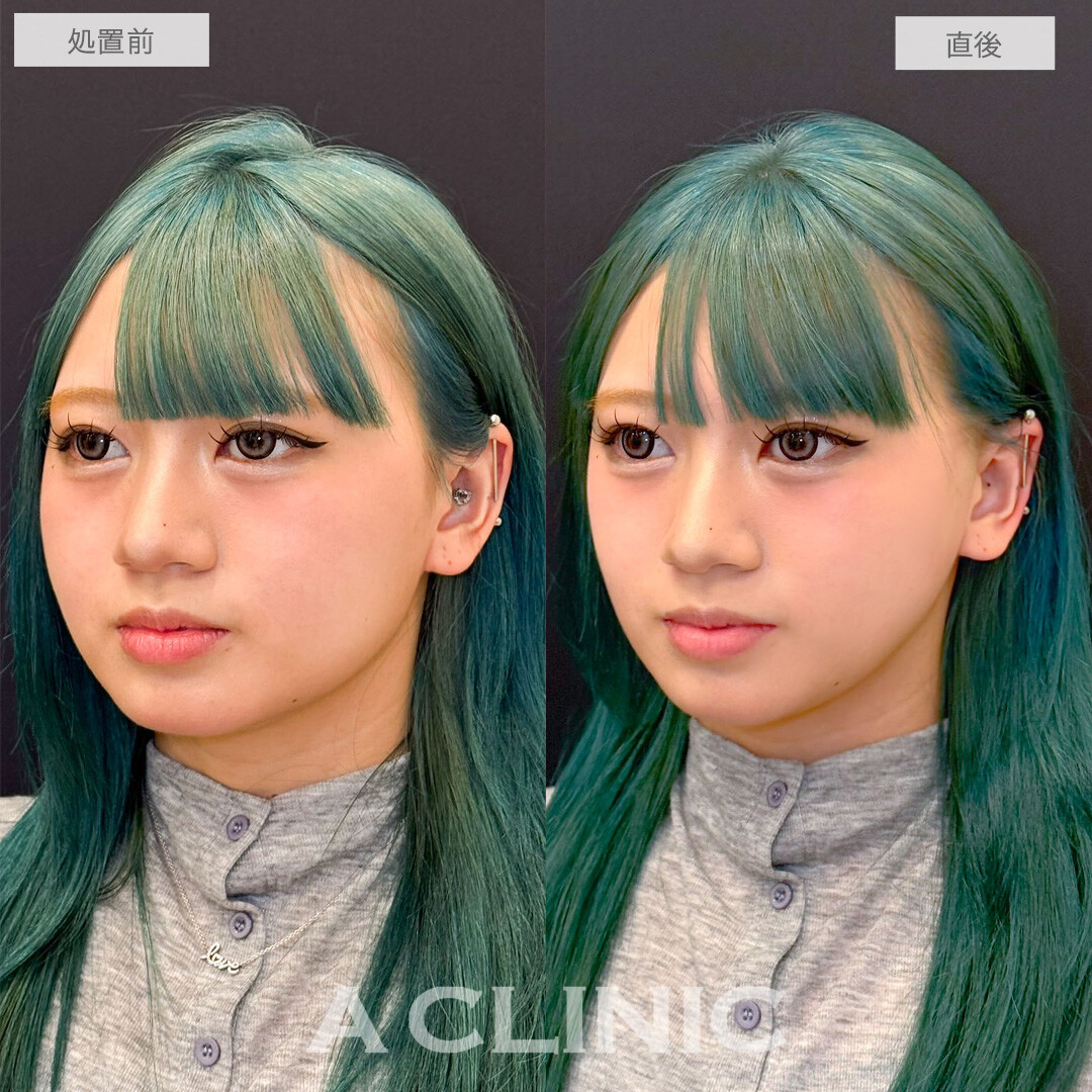 Aスレッドでフェイスラインのもたつき改善しＶフェイスに近づきました！こちら処置前と直後の症例です(20代女性)