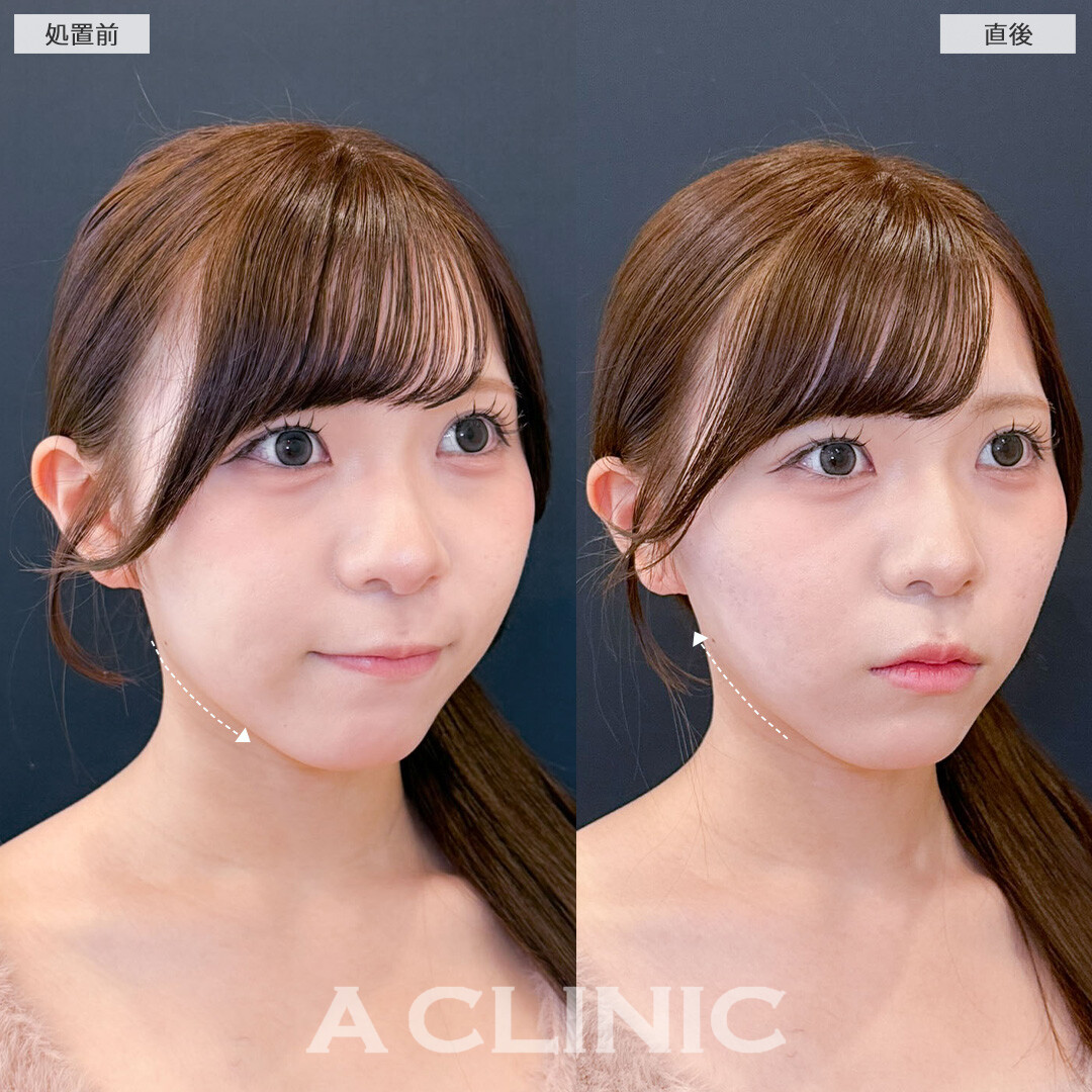 Aスレッドでキュッと引き締まった理想の小顔へ！こちら処置前と直後の症例です(10代女性)