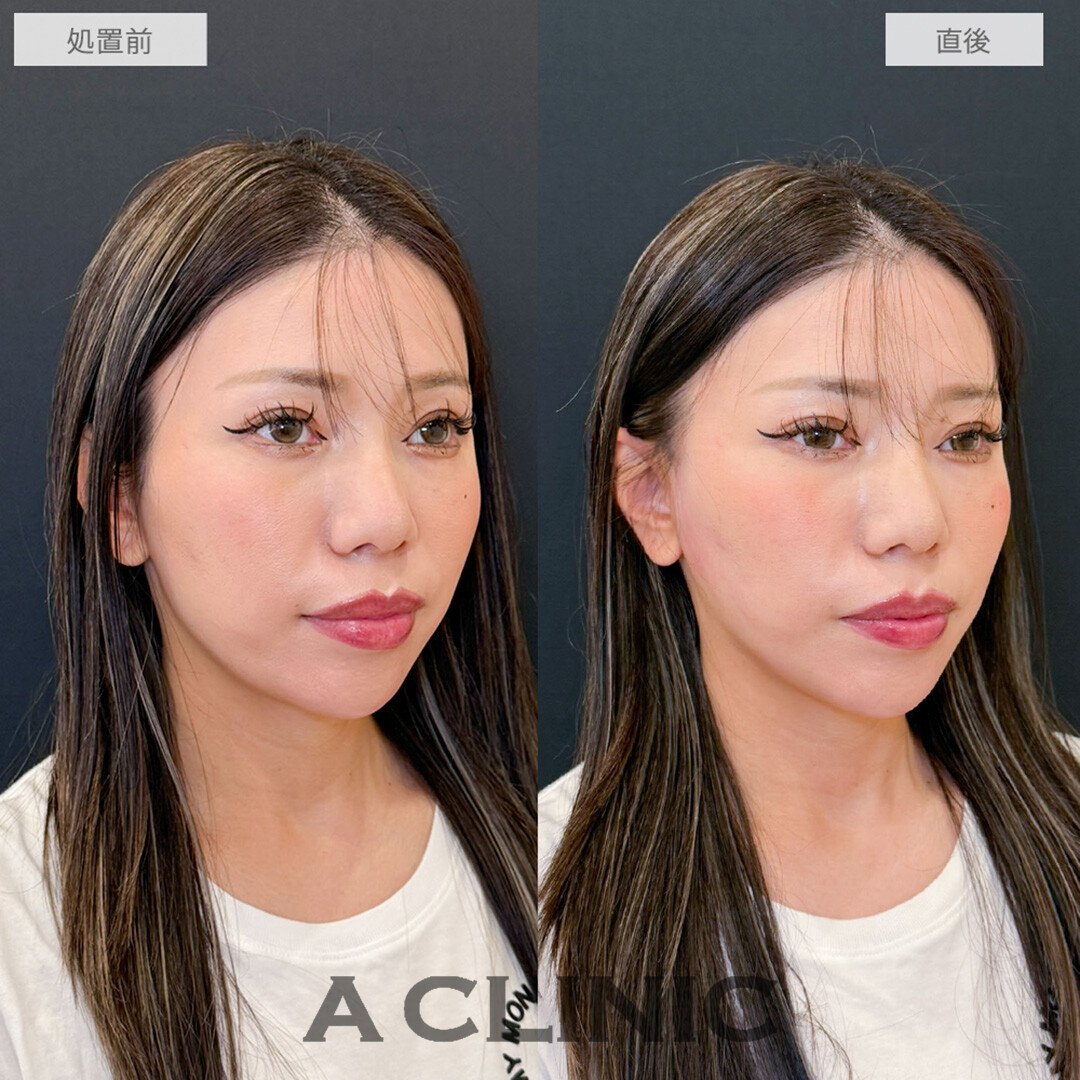 Aスレッドで直後から綺麗なVフェイスに！こちら処置前と直後の症例です(30代女性)