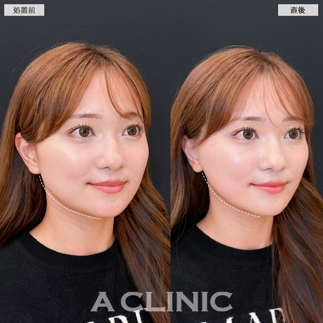 Aスレッドはたるみの予防改善と小顔効果を両立！処置前と直後の症例です(30代女性)