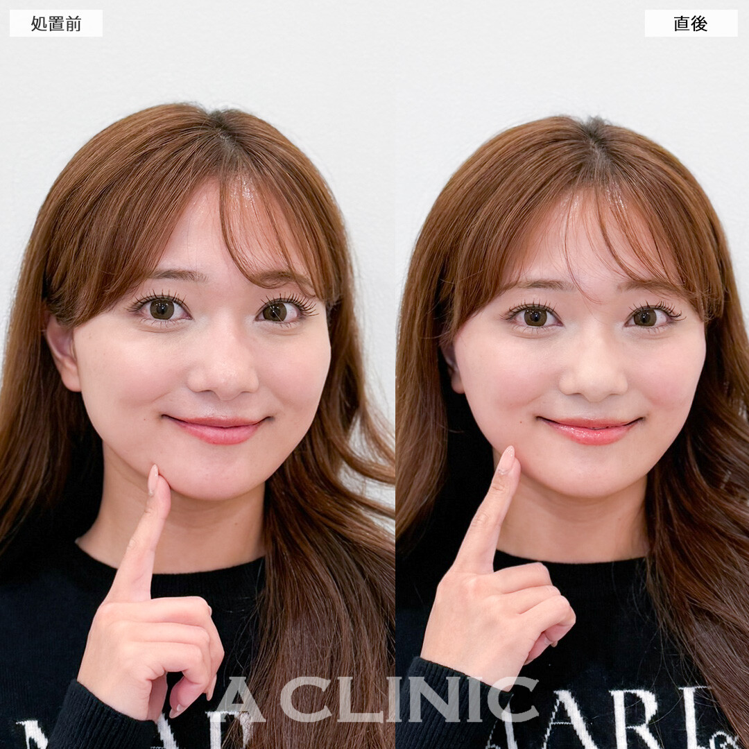 Aスレッドはたるみの予防改善と小顔効果を両立！処置前と直後の症例です(30代女性)