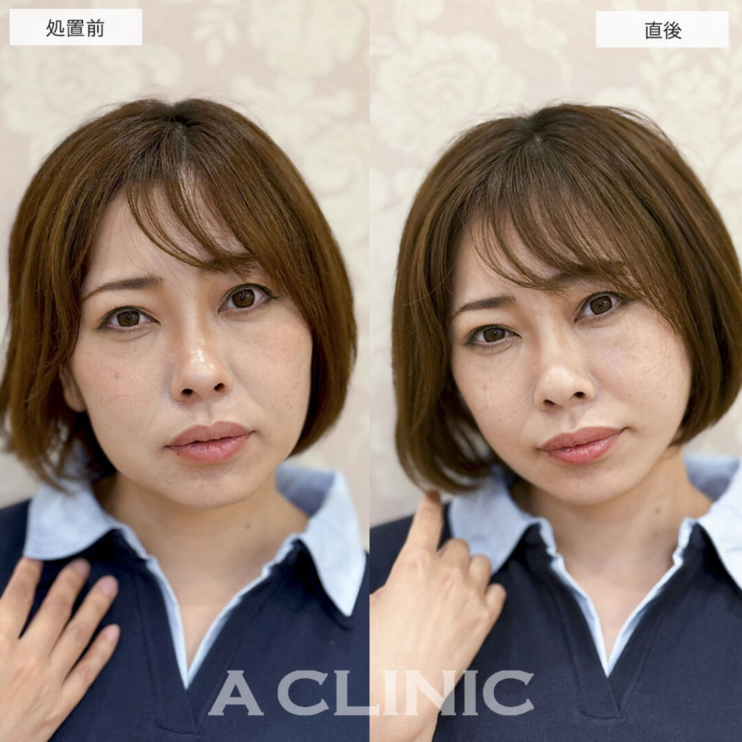 Aスレッドでナチュラルにたるみをリフトアップ!こちら処置前と直後の症例です(30代女性)