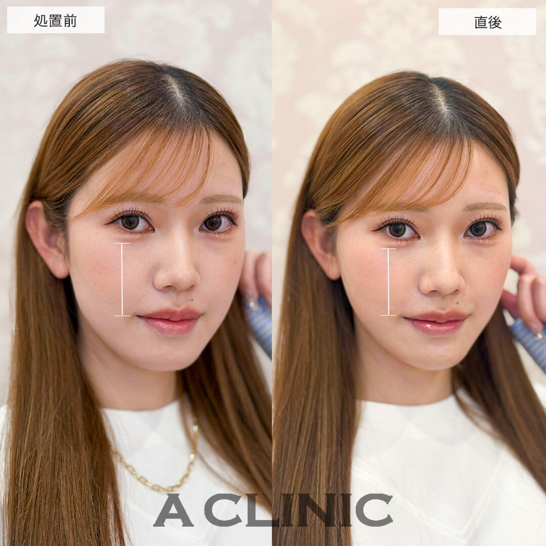Aスレッドとあごへのヒアルロン酸注入を組み合わせて理想のVフェイスへ!こちら処置前と直後の症例です(20代女性)