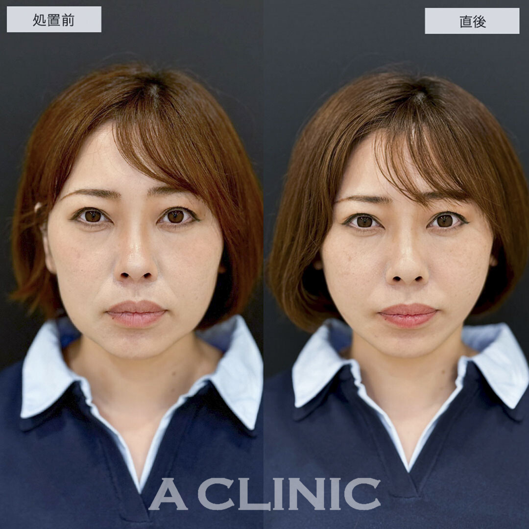 Aスレッドでナチュラルにたるみをリフトアップ!こちら処置前と直後の症例です(30代女性)