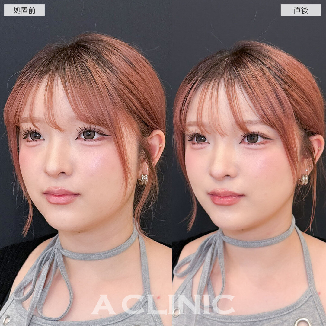Aスレッドでお顔の余白をギュッと縮めました！こちら処置前と直後の症例です(20代女性)