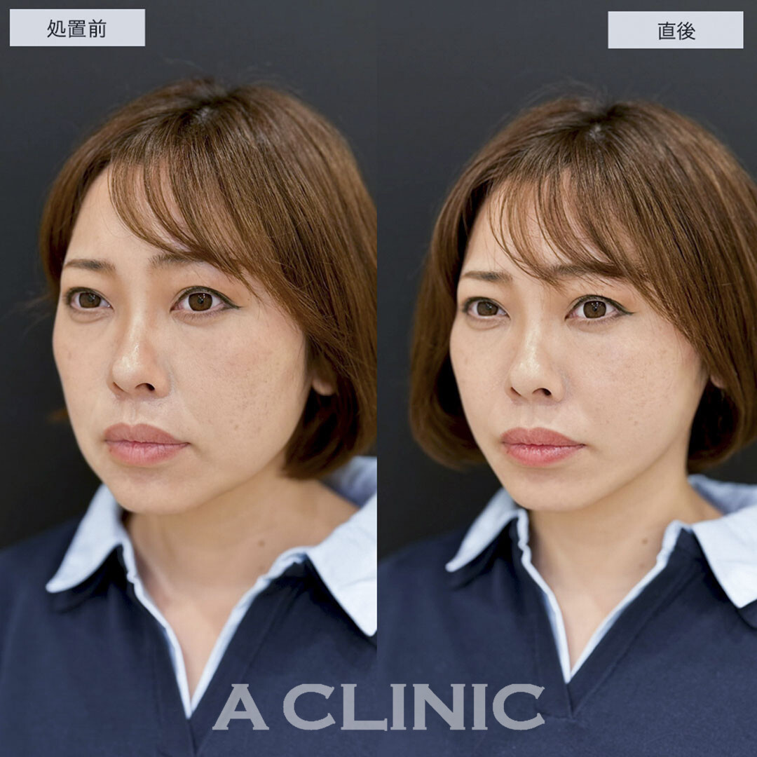 Aスレッドでナチュラルにたるみをリフトアップ!こちら処置前と直後の症例です(30代女性)